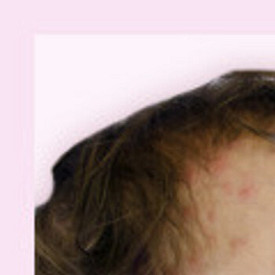 Краснуха у детей