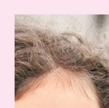 Дети с синдромом Дауна