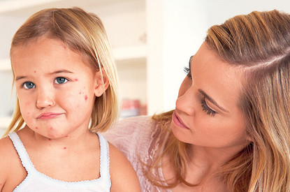 У ребенка корь: симптомы, режим, питание