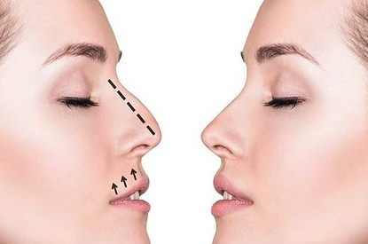 Все о ринопластике филлерами: процедура жидкий нос