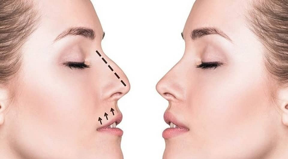 Все о ринопластике филлерами: процедура жидкий нос