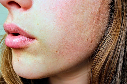 Как избавиться от комедонов на лице: все доступные способы борьбы с врагом