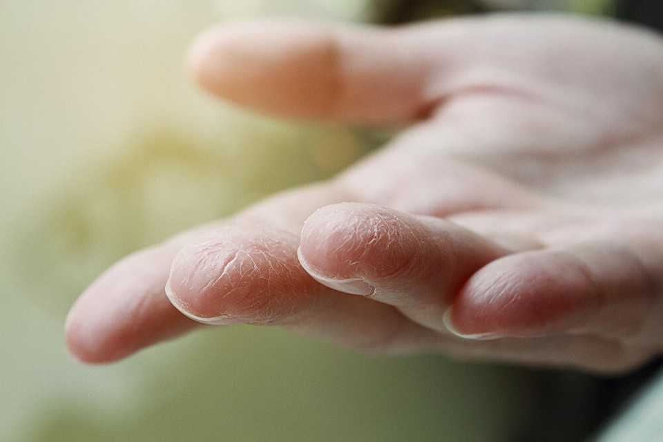 Спросили у эксперта: почему трескается кожа на пальцах рук