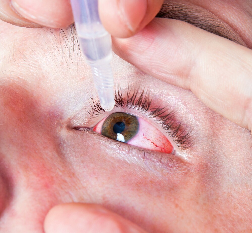 Выбираем глазные капли от конъюнктивита у взрослых
