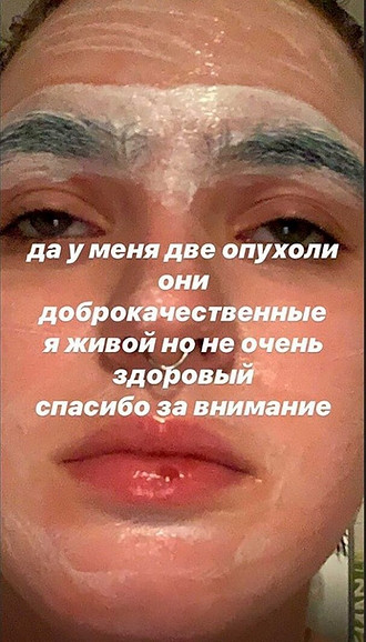 В Instagram Ольга Бухарова подтвердила, что действительно больна. «Да, у меня две опухоли. Они доброкачественные. Я живой, но не очень здоровый», - написала девушка. Впервые с подобн...