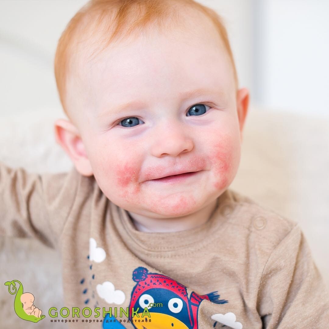 Диатез на щеках у ребенка: лечение, симптомы и профилактика | Здоровье ...