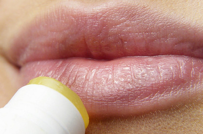 К поцелуям не зовущая: что делать, если тебя замучил герпес