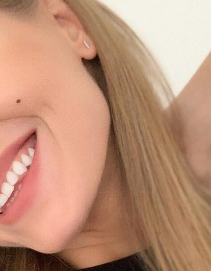 «На лице был полный трэш»: Кристина Асмус рассказала о том, как ее заразили подкожным клещом