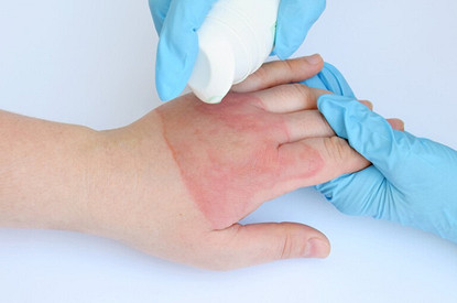 Действуй сгоряча: первая помощь при ожоге кипятком