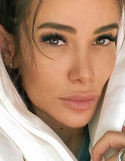 «Брови слишком высоко»: Айза Анохина показала лицо на второй день после подтяжки