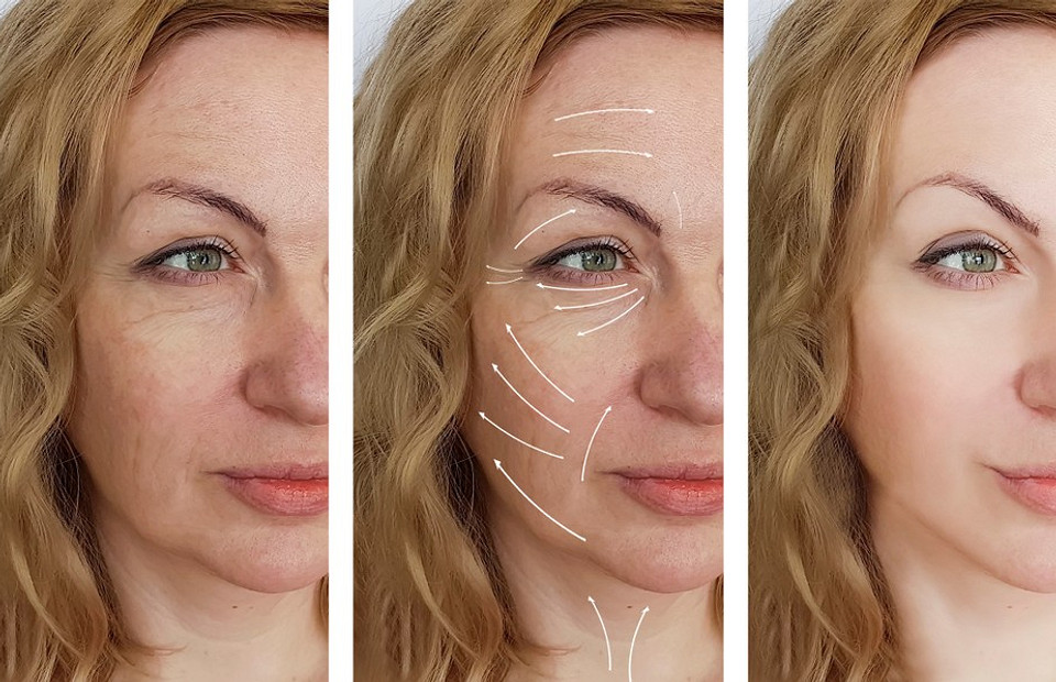 Коррекция скул филлерами: как изменить внешность за 15 минут (мнение косметолога)