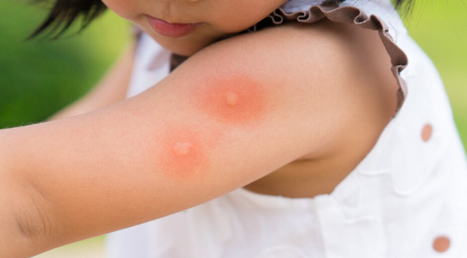 Не только клещи: 9 укусов насекомых, после которых стоит показаться врачу