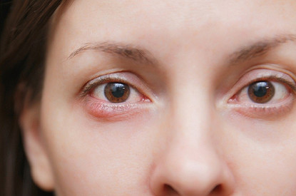 Ячмень на глазу: психосоматика возникновения (бактерии не виноваты)