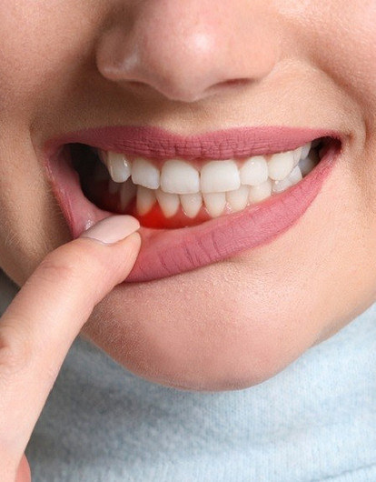 Что такое рецессия десен и 8 проблем с ротовой полостью, к которым она приводит