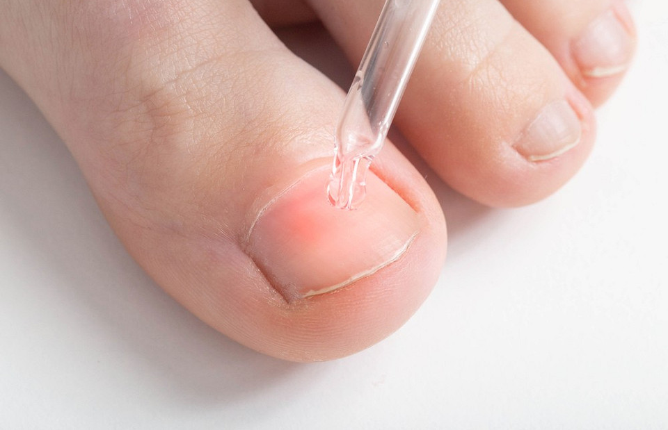 Как вылечить грибок ногтей на ногах: главные правила и ошибки, которых нельзя допускать