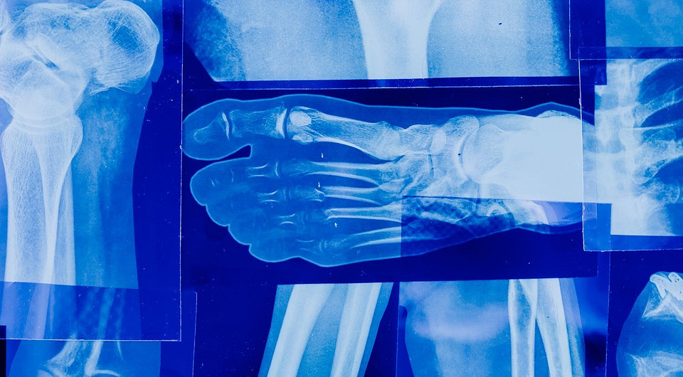 Ученые придумали импланты, которые насыщают кости полезными элементами
