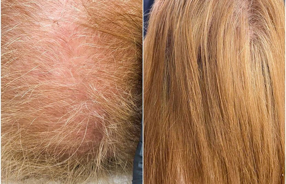 Мезотерапия для волос: все, что ты хотела знать об этой процедуре