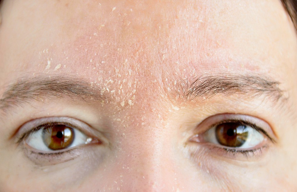 Дело не только в уходе: 7 проблем со здоровьем, из-за которых шелушится кожа на лице