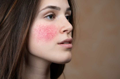 Попала в сети: 5 советов по борьбе с куперозом