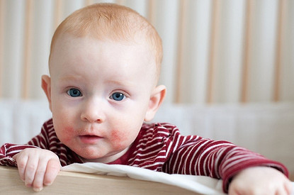 Психологические причины атопического дерматита у детей