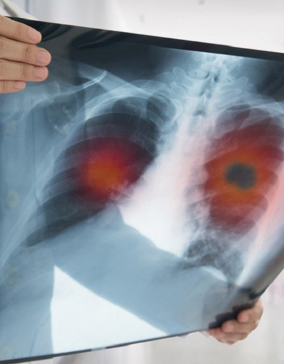 10 вопросов онкологу: как выявить рак без симптомов, какой самый опасный и что делать для профилактики