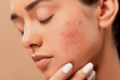 Читай по лицу: 7 эмоций, вызывающих и усиливающих акне