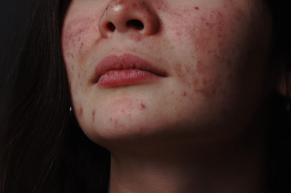 Пока не поздно: почему так важно следить за кожей именно в подростковом возрасте (и когда бежать к врачу)