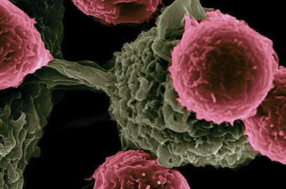 Все о тромбозе вен ног и тромбоэмболии легочной артерии: почему появляется и как коронавирус влияет на ее развитие