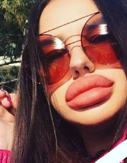 Пора «откачивать» обратно: 4 устаревших тренда в пластической хирургии