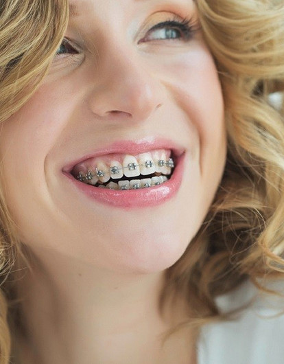 Какие брекеты подойдут именно тебе (гид от стоматолога)