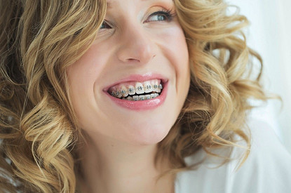Какие брекеты подойдут именно тебе (гид от стоматолога)