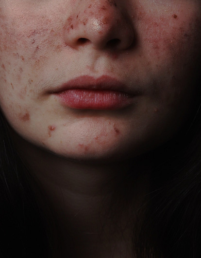 Невероятно, но факт: как справиться с розацеа с помощью остеопатии