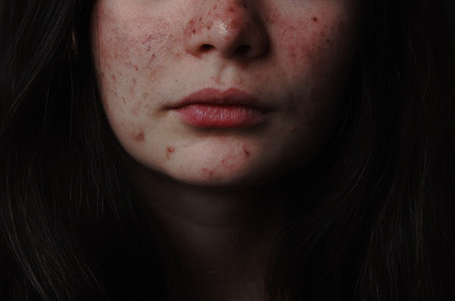 Невероятно, но факт: как справиться с розацеа с помощью остеопатии