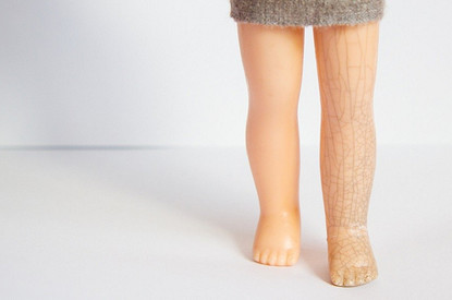 Что нельзя делать при варикозе и чем это может быть опасно