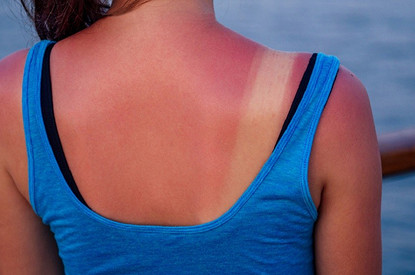 Перезагорала: что делать, если обгорела на солнце (первая помощь и средства для домашнего лечения)