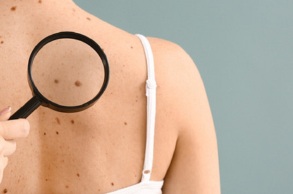 Смотри не перепутай: 4 отличия обычных родинок от опасных