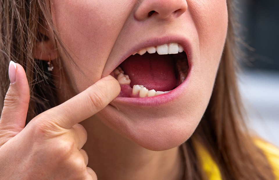 Больно, долго, дорого: 5 главных мифов по установке зубов