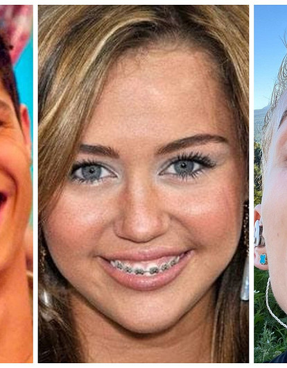 Брекеты как звездный тренд: почему знаменитости демонстрируют их всему миру