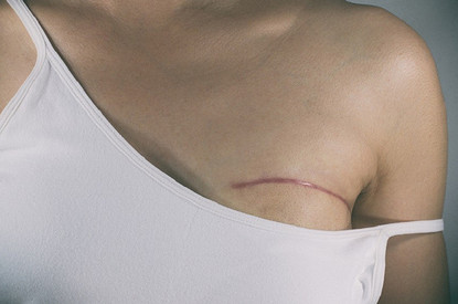 Пластика груди после онкологии: как восстановить красоту