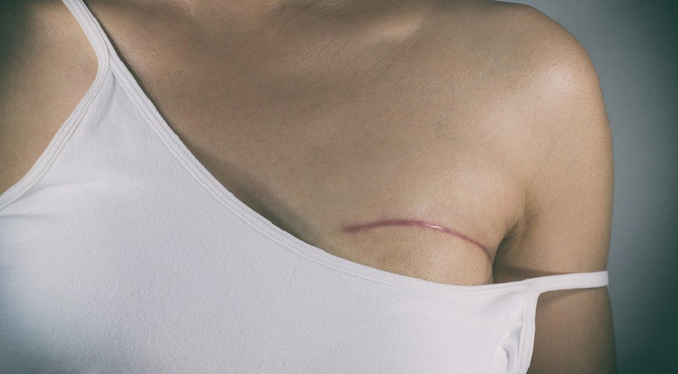 Пластика груди после онкологии: как восстановить красоту