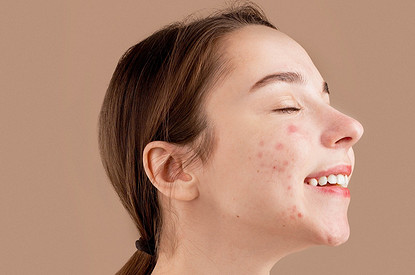 Мастер маскировки: выбираем тональный крем для проблемной кожи