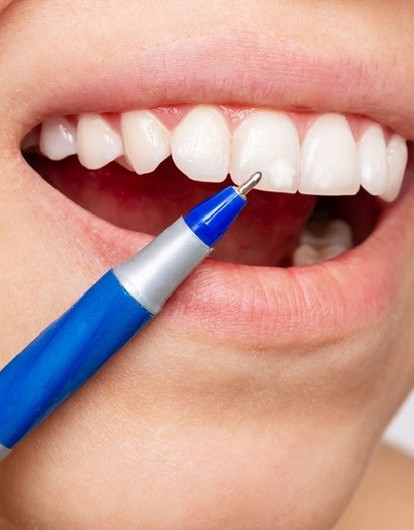 Белые пятна на зубах у ребенка и взрослого: главные причины и методы избавления