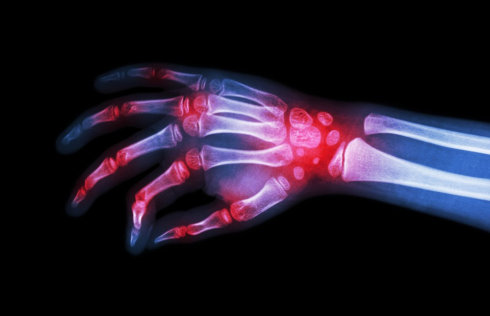 5 типов артрита: почему важно знать симптомы каждого