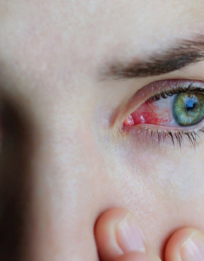 Конъюнктивит: лечение и что делать, чтобы он не появился повторно