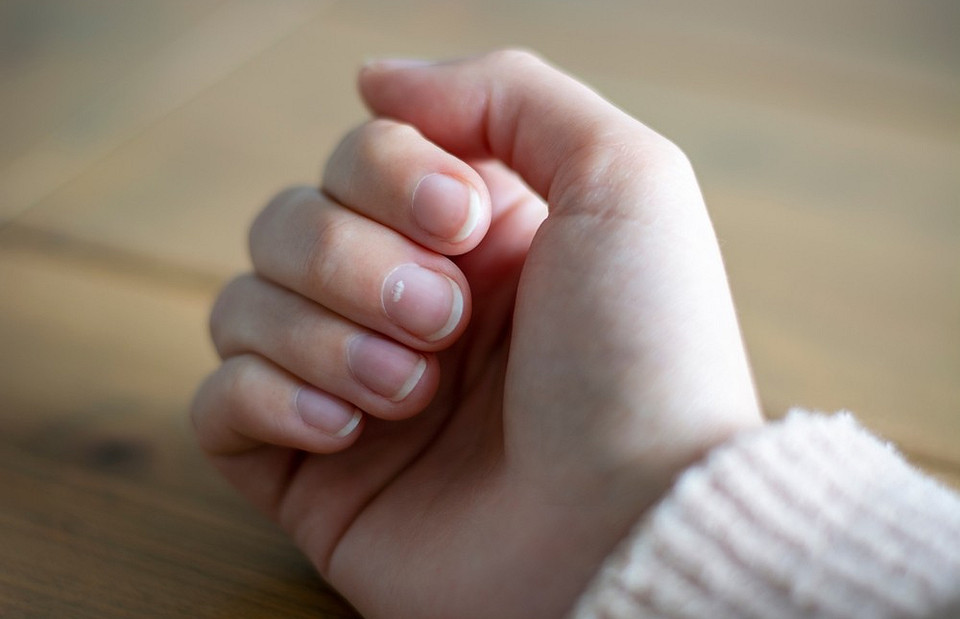 От неграмотного маникюра до отравления: откуда берутся белые пятна на ногтях рук