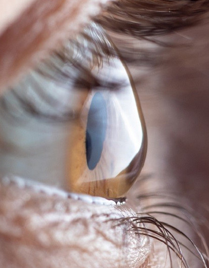 Лечение астигматизма: 3 главных способа (и как определить его самостоятельно)