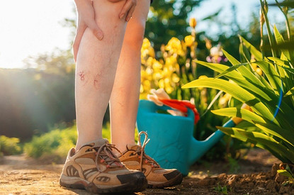 Сосудистые звездочки на лице и ногах: 11 причин и 9 современных способов лечения