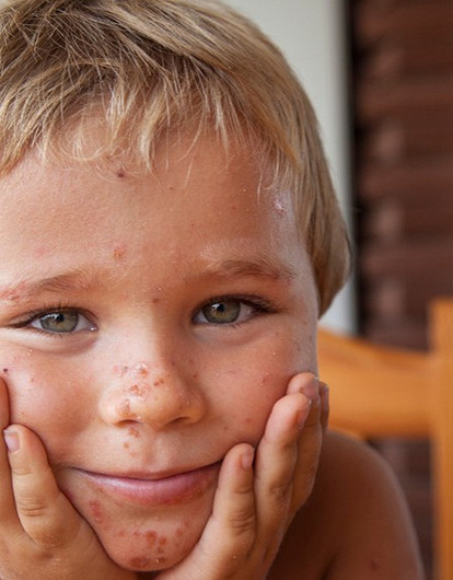 Сыпь у ребенка: что должна знать мама малыша (спросили у эксперта)