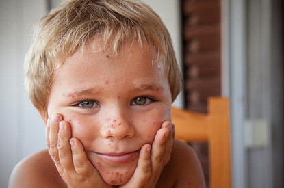 Сыпь у ребенка: что должна знать мама малыша (спросили у эксперта)