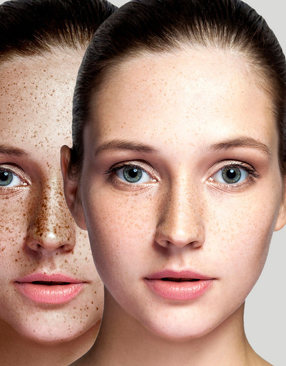 Омоложение BBL: в чем плюсы и есть ли минусы